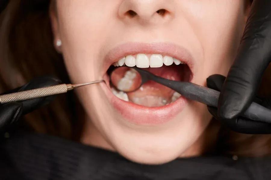 composite-resin-filling