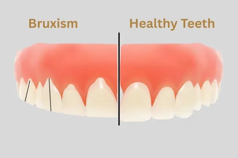 bruxism-vs-healthy-teeth