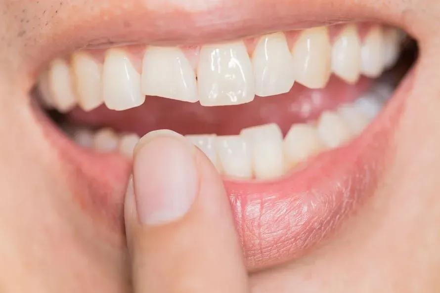 cracked-tooth-890x593