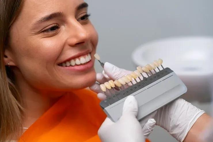 veneer-shade-guide-smile