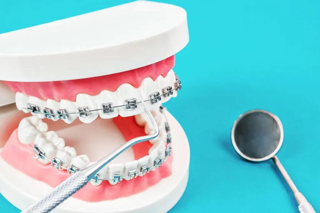 what-are-dental-braces-1024x683