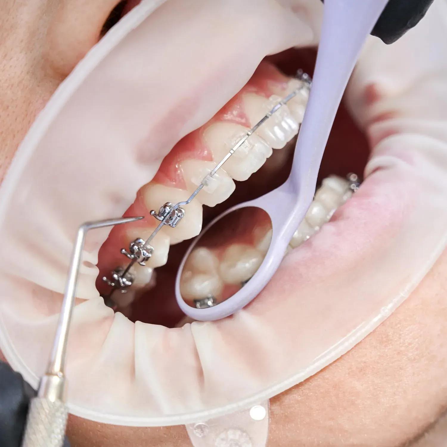 braces