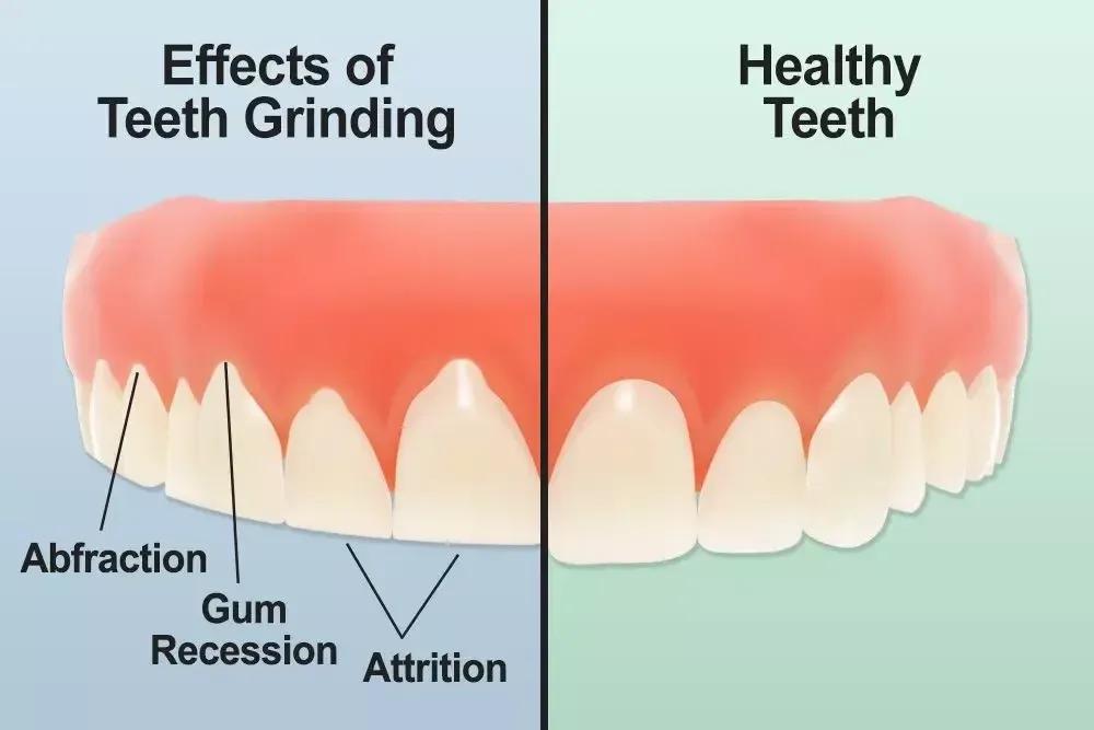 grinding-vs-healthy-teeth-1000x667
