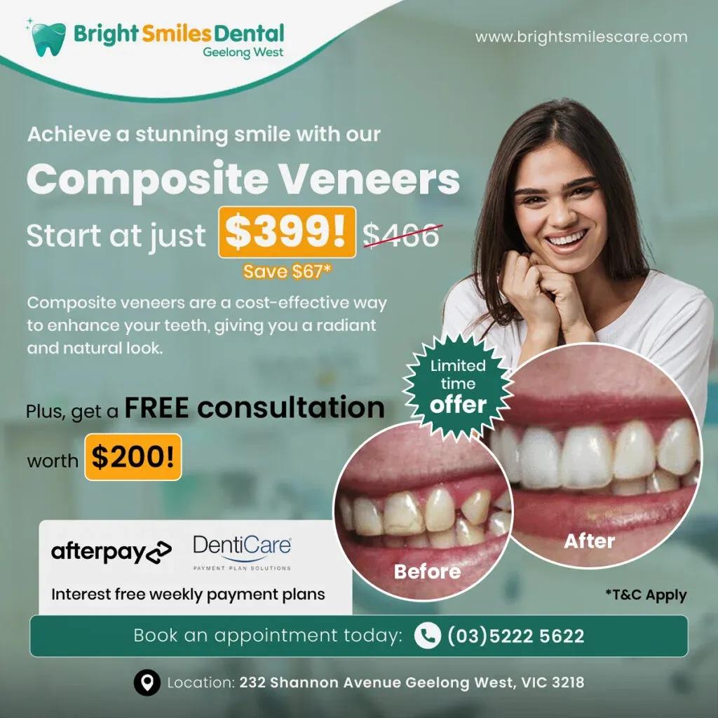 composite-veneers-offer