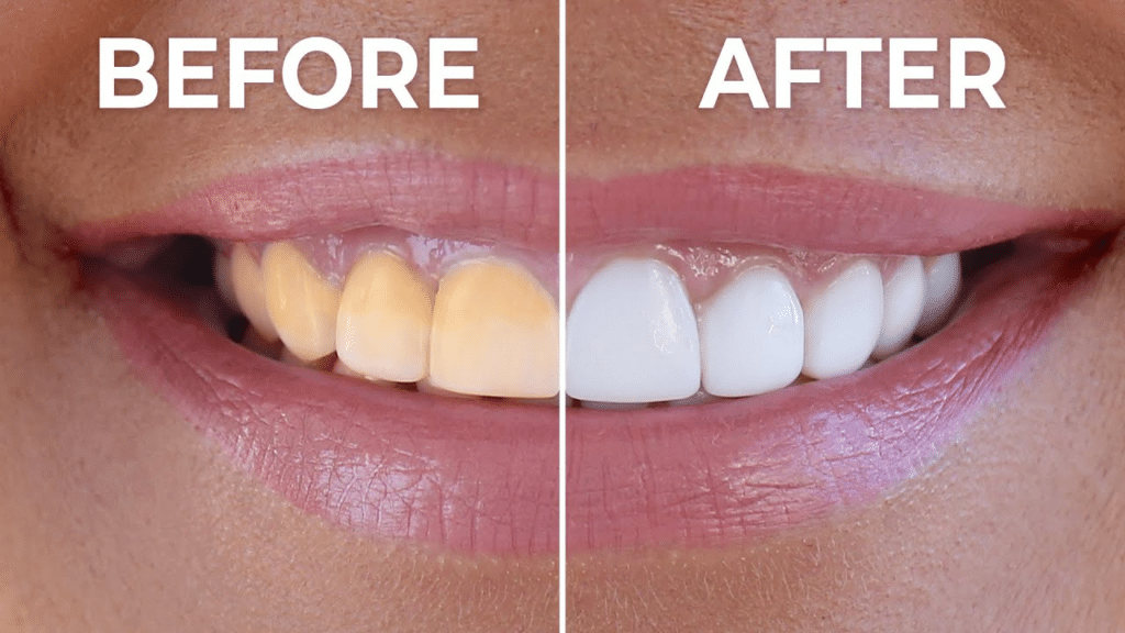 Teeth Whitening Do’s and Don’ts: Tips for a Healthy, Radiant Smile