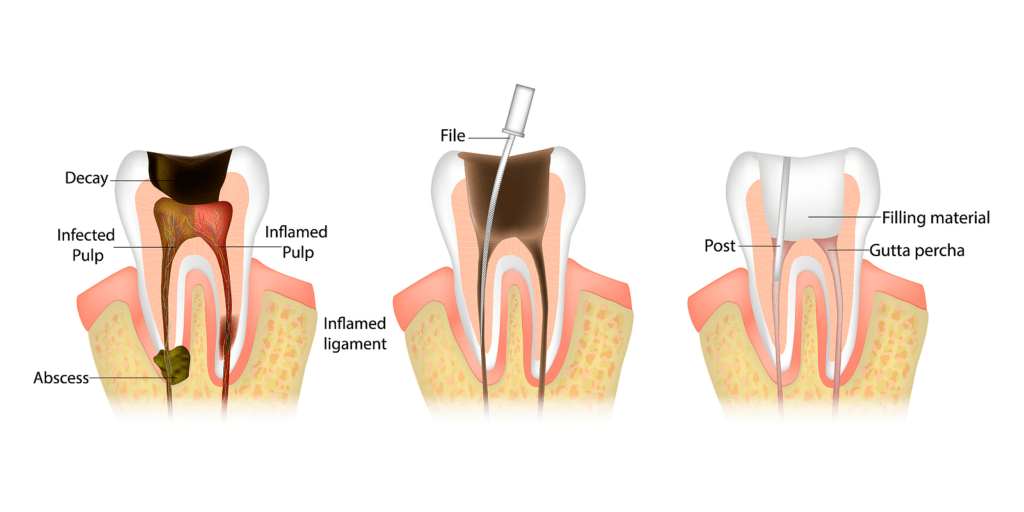 What is Root Canal Treatment?
