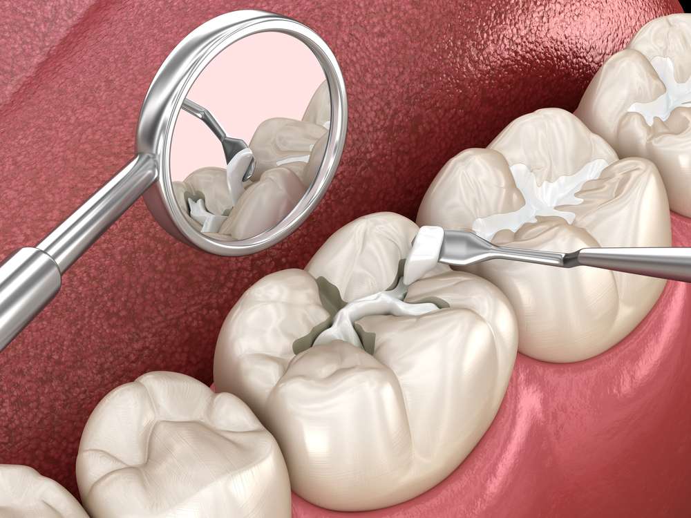 Placing Composite Filling by Cosmetic Dentists