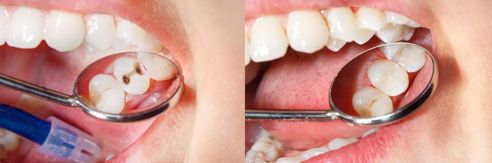 Composite Fillings in Geelong - Before and After