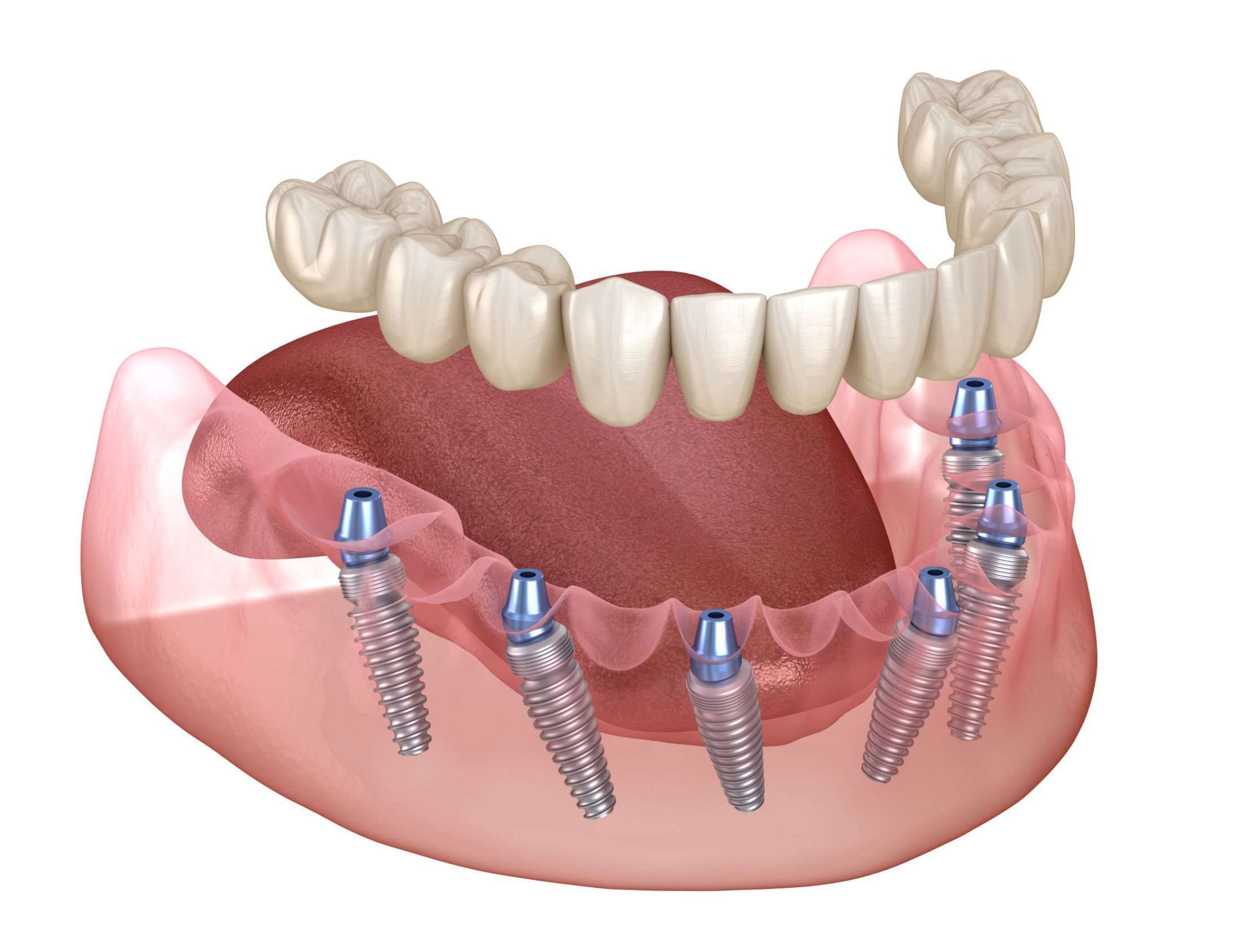 Full Arch Implants for Complete Teeth Replacement