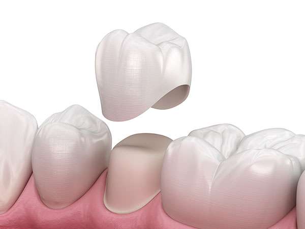 Dental Crowns for Teeth in Geelong West