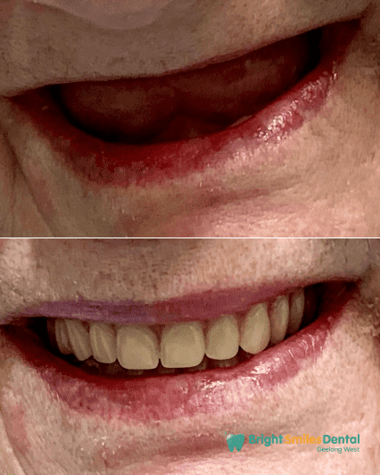 Dental Implant Before and After