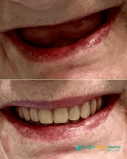 Dental Implant Before and After