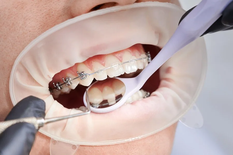 Doctors doing dental Braces