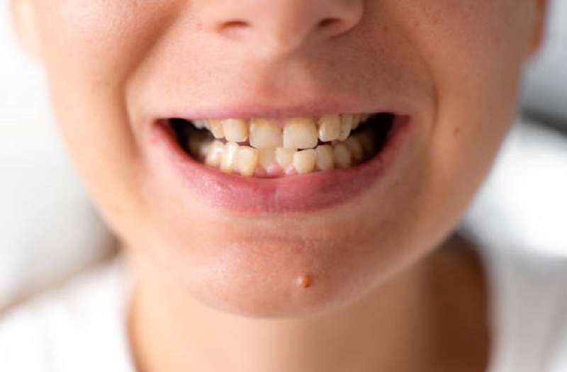Invisalign For the Uneven Teeths