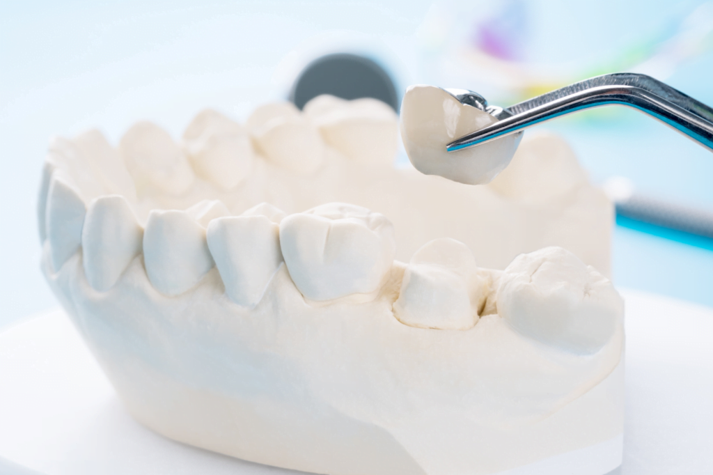 Dental Crowns in Geelong