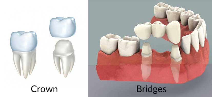 How Crowns & Bridges Improve Your Dental Health with Geelong West Bright Smiles Dental