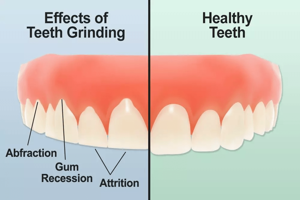 Grinding or Clenching Your Teeth