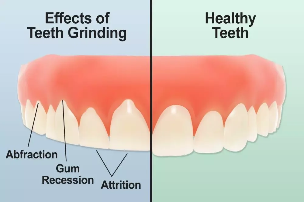 Grinding or Clenching Your Teeth