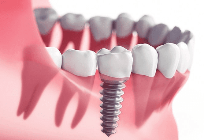 Dental Implant