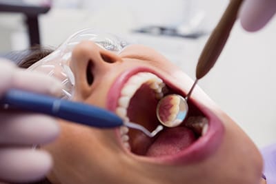 Composite-Fillings