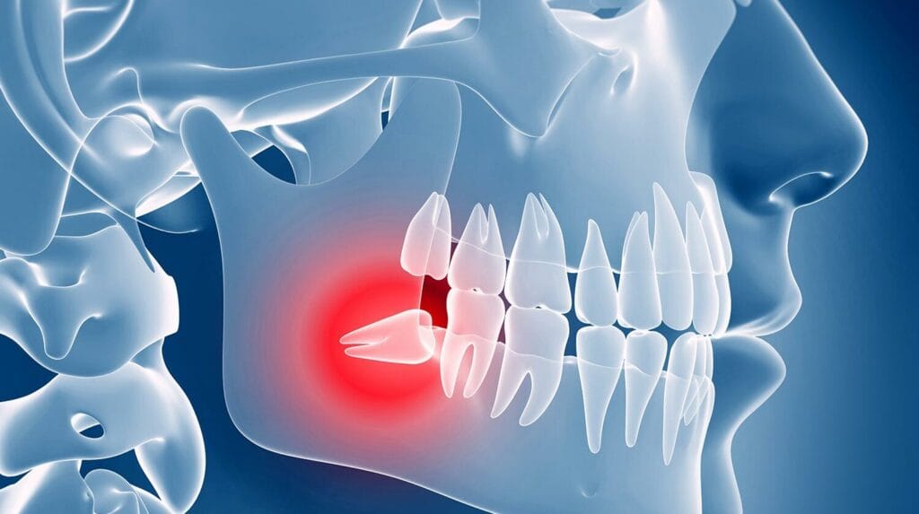 What Time Is Best for Wisdom Tooth Extraction? Remarks from dentists in Geelong