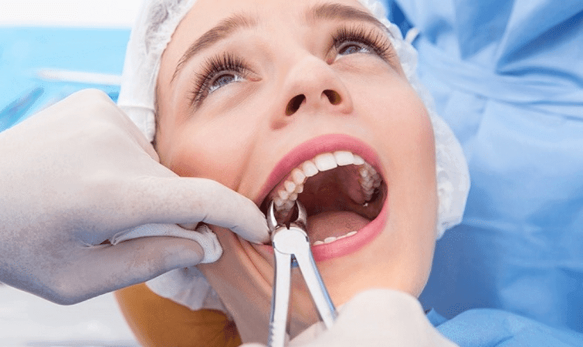 Wisdom Tooth Extraction