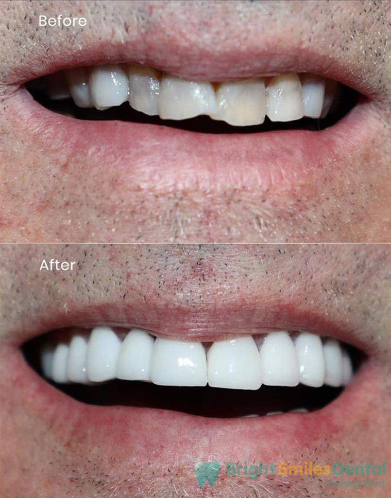 Before_And_After_Image