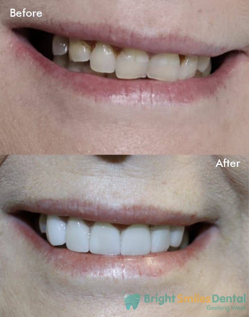 teeth-before-after_1