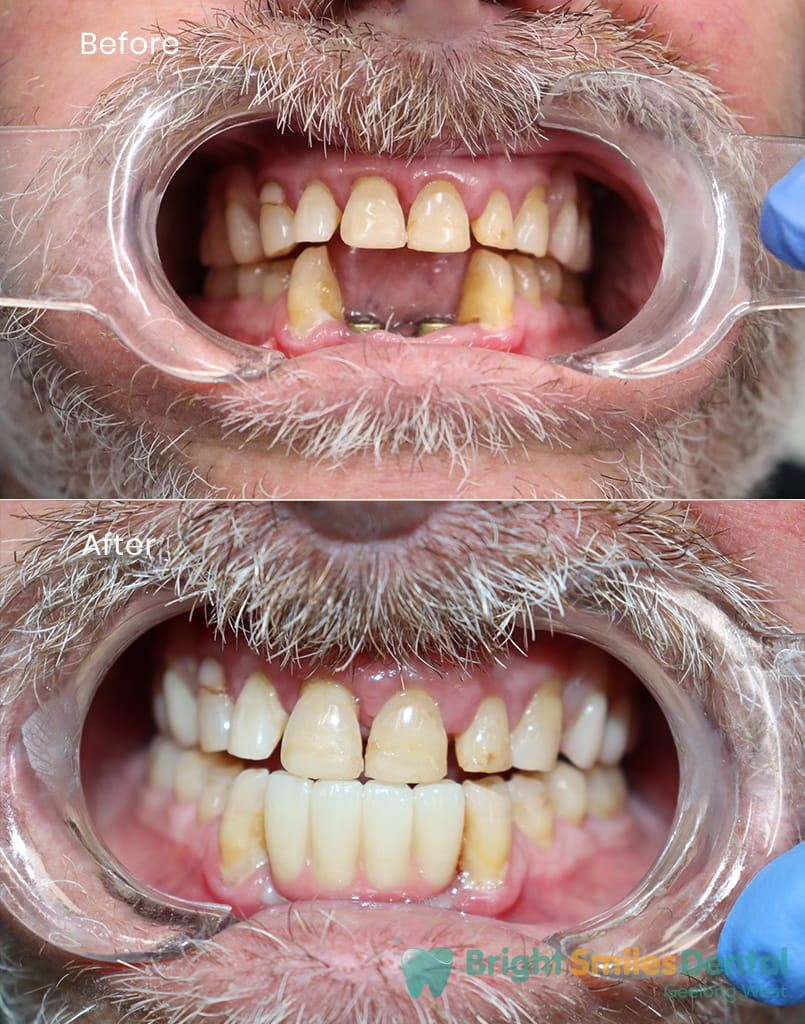 Implant_CaseBefore-And-After