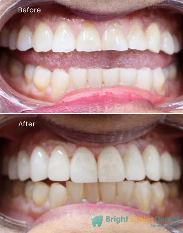 Holly-wood-smile-makeover_Before-And_After-1