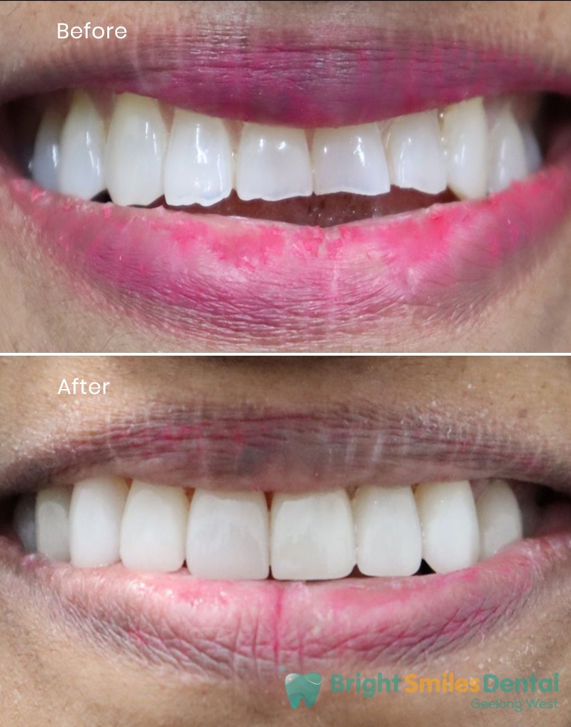 Holly-wood-smile-makeover_Before-And_After