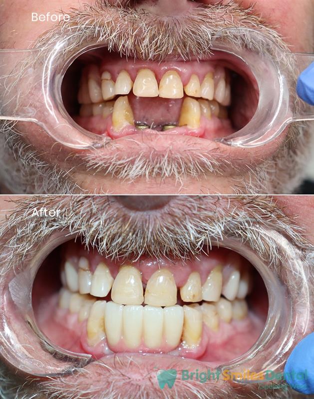 Implant_CaseBefore-And-After 1