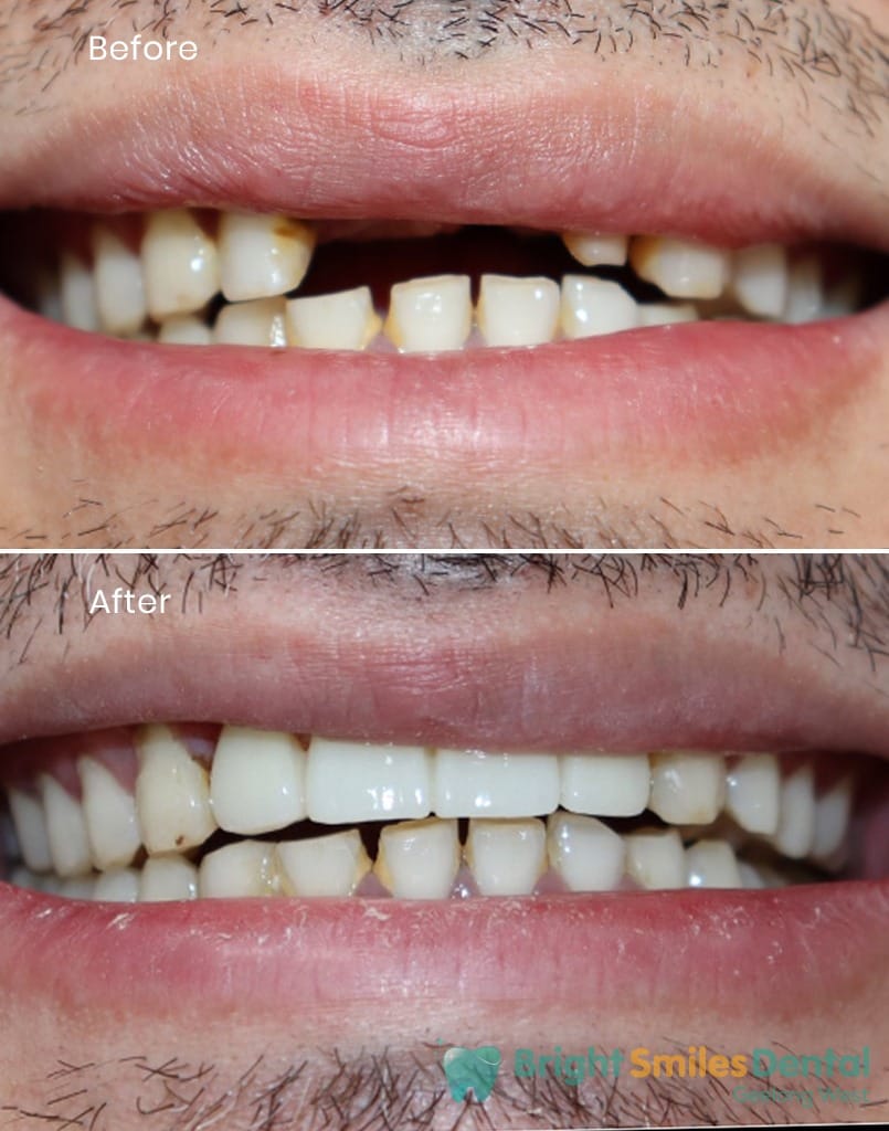 Case-22-Crown-and-Bridge__Before-And_After-1