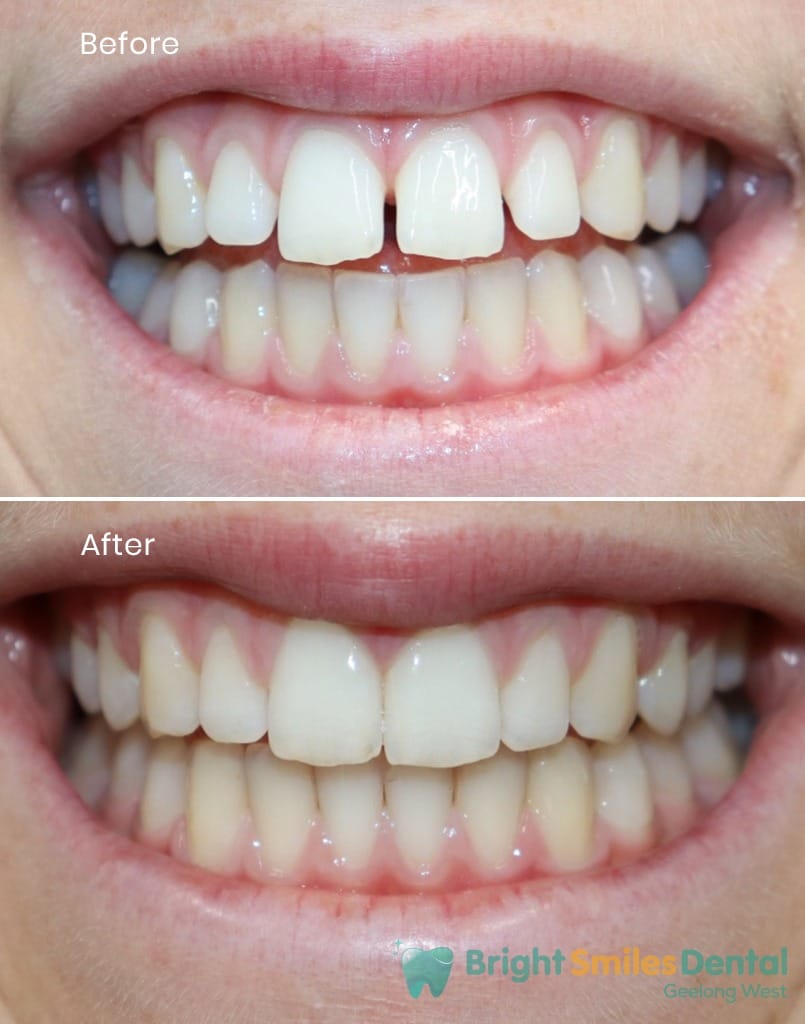 Gap_Closed_with_Aligners_Before-And_After-2